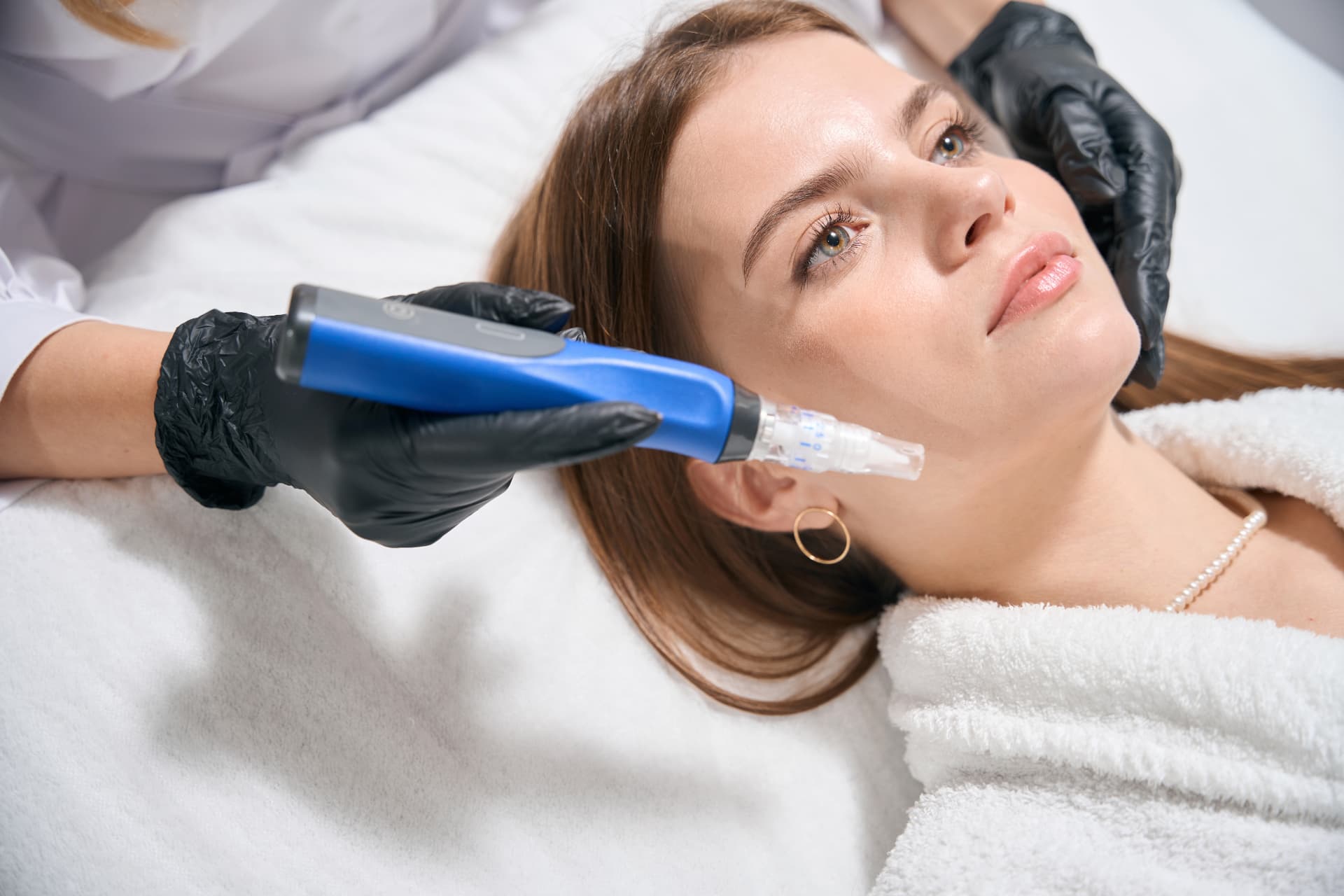 SkinPen Microneedling-Behandlung